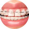 brackets