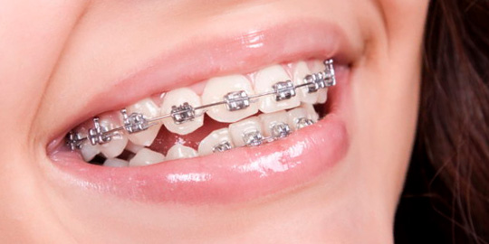 brackets