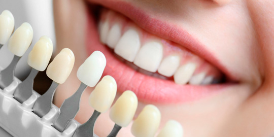 veneers